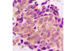 Immunohistochemical analysis of ALDOB staining in human breast cancer formalin fixed paraffin embedded tissue section.