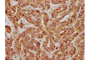 IHC image of ABIN7146984 diluted at 1:500 and staining in paraffin-embedded human liver cancer performed on a Leica BondTM system.