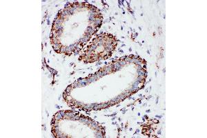 Anti-MTCO1 antibody,  IHC(P) IHC(P): Human Mammary Cancer Tissue