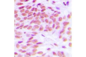 Immunohistochemical analysis of GATA1 staining in human breast cancer formalin fixed paraffin embedded tissue section. (GATA1 anticorps  (Center))