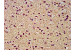 IHC image of ABIN7171980 diluted at 1:300 and staining in paraffin-embedded human glioma performed on a Leica BondTM system.