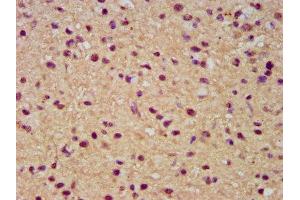 IHC image of ABIN7171980 diluted at 1:300 and staining in paraffin-embedded human glioma performed on a Leica BondTM system. (SLC19A2 anticorps  (AA 209-285))