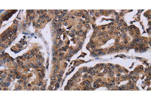 Immunohistochemistry of paraffin-embedded Human breast cancer using KIF1C Polyclonal Antibody at dilution of 1:60 (KIF1C anticorps)