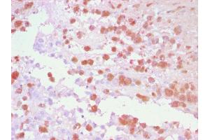 Formalin-fixed, paraffin-embedded human Melanoma stained with TYRP1 Rabbit Polyclonal Antibody using AEC Chromogen (red). (Tyrosinase-Related Protein 1 anticorps)