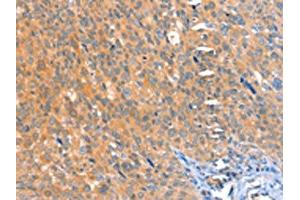 The image on the left is immunohistochemistry of paraffin-embedded Human cervical cancer tissue using ABIN7128174(ACOX3 Antibody) at dilution 1/25, on the right is treated with fusion protein. (ACOX3 anticorps)