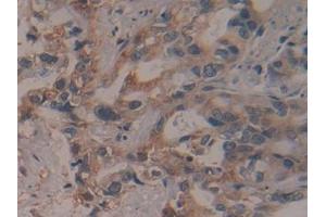 Detection of PSMD13 in Human Pancreatic cancer Tissue using Polyclonal Antibody to Proteasome 26S Subunit, Non ATPase 13 (PSMD13)