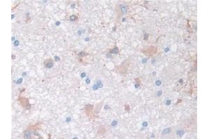 Detection of MMP3 in Human Glioma Tissue using Monoclonal Antibody to Matrix Metalloproteinase 3 (MMP3)