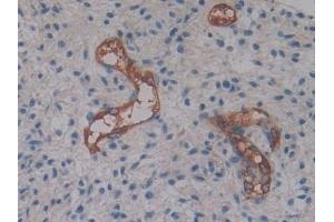Detection of CYTH2 in Human Glioma Tissue using Polyclonal Antibody to Cytohesin 2 (CYTH2)