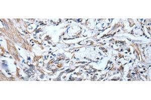 Immunohistochemistry of paraffin-embedded Human gastric cancer tissue using STRADA Polyclonal Antibody at dilution of 1:45(x200) (STRADA anticorps)