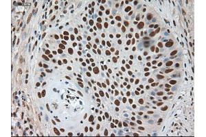 Immunohistochemical staining of paraffin-embedded Adenocarcinoma of breast using anti-Notch1 (ABIN2452671) mouse monoclonal antibody. (Notch1 anticorps  (AA 2300-2556))