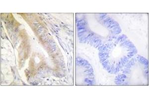 Immunohistochemistry analysis of paraffin-embedded human colon carcinoma tissue, using IREB1 (Ab-138) Antibody. (Aconitase 1 anticorps  (AA 106-155))