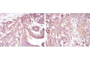 Immunohistochemical analysis of paraffin-embedded stomach cancer tissues (left) and brain tumor tissues (right) using HIF1A mouse mAb with DAB staining.