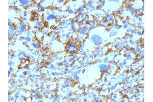 Formalin-fixed, paraffin-embedded human Histiocytoma stained with HLA-DR Monoclonal Antibody (SPM423). (HLA-DRB1 anticorps)