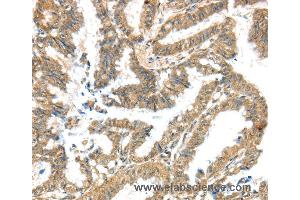 Immunohistochemistry of Human liver cancer using KCNG3 Polyclonal Antibody at dilution of 1:40 (KCNG3 anticorps)