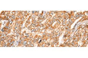 Immunohistochemistry of paraffin-embedded Human liver cancer tissue using ZMYND10 Polyclonal Antibody at dilution of 1:35(x200)