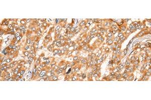 Immunohistochemistry of paraffin-embedded Human liver cancer tissue using ZMYND10 Polyclonal Antibody at dilution of 1:35(x200) (ZMYND10 anticorps)
