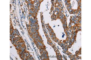Immunohistochemistry of Human lung cancer using ALG2 Polyclonal Antibody at dilution of 1:35