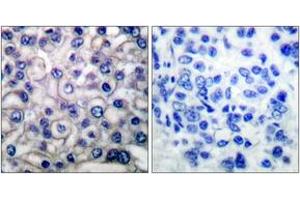 Immunohistochemistry analysis of paraffin-embedded human breast carcinoma tissue, using EGFR (Ab-693) Antibody. (EGFR anticorps  (AA 661-710))