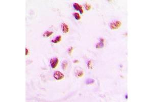 Immunohistochemical analysis of RAD50 staining in human lung cancer formalin fixed paraffin embedded tissue section.