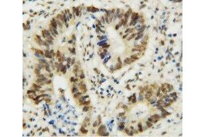 Anti-MTA1 antibody, IHC(P) IHC(P): Human Rectal Cancer Tissue (MTA1 anticorps  (C-Term))