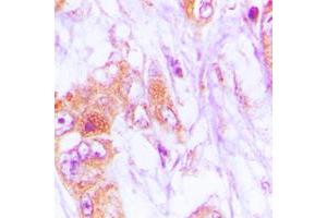 Immunohistochemical analysis of CDKL4 staining in human lung cancer formalin fixed paraffin embedded tissue section. (CDKL4 anticorps  (C-Term))