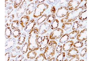 Formalin-fixed, paraffin-embedded human Renal Cell Carcinoma stained with Laminin Rat Monoclonal Antibody (A5). (Laminin gamma 1 anticorps)