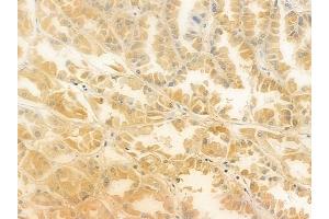 ABIN6265742 and ABIN6278197 at 1/100 staining human renal cell carcinoma by IHC-P.