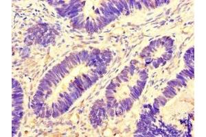 Immunohistochemistry of paraffin-embedded human ovarian cancer using ABIN7145075 at dilution of 1:100 (Aurora A anticorps  (AA 1-131))