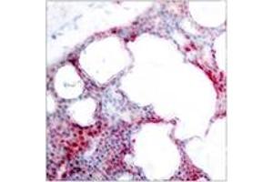 Immunohistochemistry analysis of paraffin-embedded human breast carcinoma, using ATF2 (Phospho-Ser62 or 44) Antibody.
