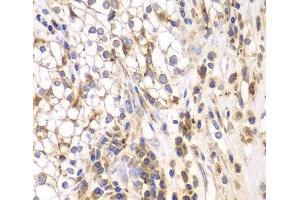 Immunohistochemistry of paraffin-embedded Human kidney cancer using SRPK1 Polyclonal Antibody at dilution of 1:200 (40x lens). (SRPK1 anticorps)