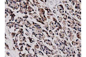 Immunohistochemical staining of paraffin-embedded Adenocarcinoma of Human colon tissue using anti-HDAC6 mouse monoclonal antibody. (HDAC6 anticorps)