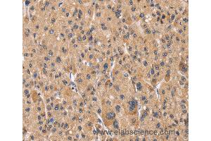 Immunohistochemistry of Human liver cancer using PPIF Polyclonal Antibody at dilution of 1:60 (PPIF anticorps)