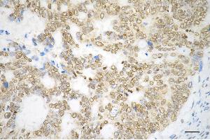 Immunohistochemistry was performed on paraffin-embedded human sigmoid colon carcinoma using PTBP1 antibody (ABIN7799882), 1:200). (Recombinant PTBP1 anticorps)
