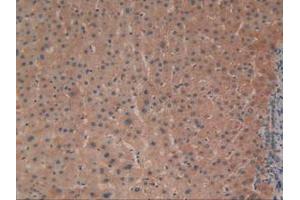 IHC-P analysis of Human Liver Cancer Tissue, with DAB staining. (ADCY3 anticorps  (AA 501-736))