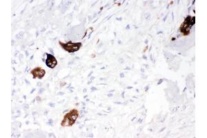 Cathepsin K was detected in paraffin-embedded sections of human osteosarcoma tissues using rabbit anti- Cathepsin K Antigen Affinity purified polyclonal antibody at 1 μg/mL. (Cathepsin K anticorps  (AA 115-329))