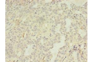 Immunohistochemistry of paraffin-embedded human breast cancer using ABIN7158260 at dilution of 1:100 (LILRA4 anticorps  (AA 289-424))
