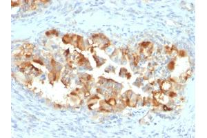 Formalin-fixed, paraffin-embedded human Endometrial Carcinoma stained with Mesothelin Mouse Monoclonal Antibody (MSLN/2131). (Mesothelin anticorps  (AA 273-407))