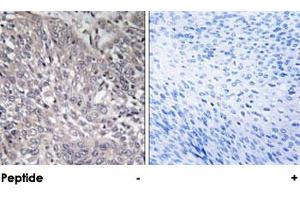 Immunohistochemical analysis of paraffin-embedded human cervix carcinoma tissue using ITPR1 polyclonal antibody .