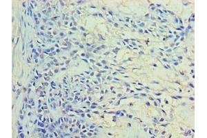 Immunohistochemistry of paraffin-embedded human breast cancer using ABIN7167221 at dilution of 1:100 (RAB11A anticorps  (AA 2-213))