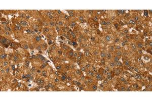 Immunohistochemistry of paraffin-embedded Human liver cancer tissue using TBC1D1 Polyclonal Antibody at dilution 1:45 (TBC1D1 anticorps)