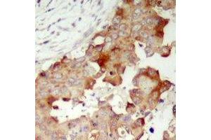 Immunohistochemical analysis of POTEB staining in human prostate cancer formalin fixed paraffin embedded tissue section.