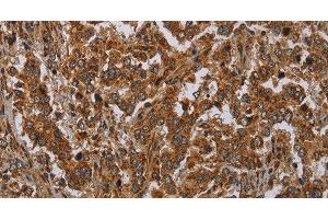 Immunohistochemistry of paraffin-embedded Human liver cancer tissue using ATP2A1 Polyclonal Antibody at dilution 1:30 (ATP2A1/SERCA1 anticorps)