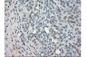 Immunohistochemical staining of paraffin-embedded Adenocarcinoma of colon tissue using anti-NEK6mouse monoclonal antibody. (NEK6 anticorps)