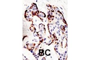 Formalin-fixed and paraffin-embedded human cancer tissue reacted with the primary antibody, which was peroxidase-conjugated to the secondary antibody, followed by DAB staining.