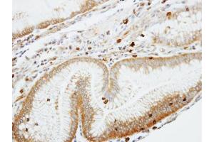 IHC-P Image Immunohistochemical analysis of paraffin-embedded human gastric cancer, using Coronin 1A, antibody at 1:100 dilution. (Coronin 1a anticorps  (C-Term))
