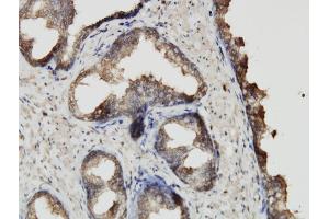Immunoperoxidase of monoclonal antibody to ABCF2 on formalin-fixed paraffin-embedded human prostate.