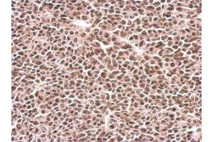 IHC-P Image PFKFB3 antibody [C3], C-term detects PFKFB3 protein at nucleus on BT483 xenograft by immunohistochemical analysis.