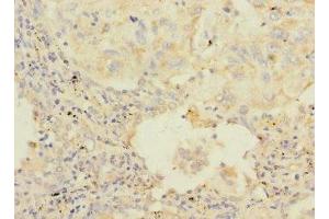 Immunohistochemistry of paraffin-embedded human lung cancer using ABIN7154845 at dilution of 1:100 (HAND1 anticorps  (AA 16-215))