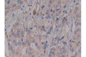 Detection of Rock2 in Human Breast cancer Tissue using Polyclonal Antibody to Rho Associated Coiled Coil Containing Protein Kinase 2 (Rock2)