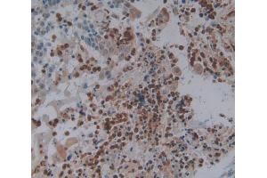 IHC-P analysis of skin cancer tissue, with DAB staining.